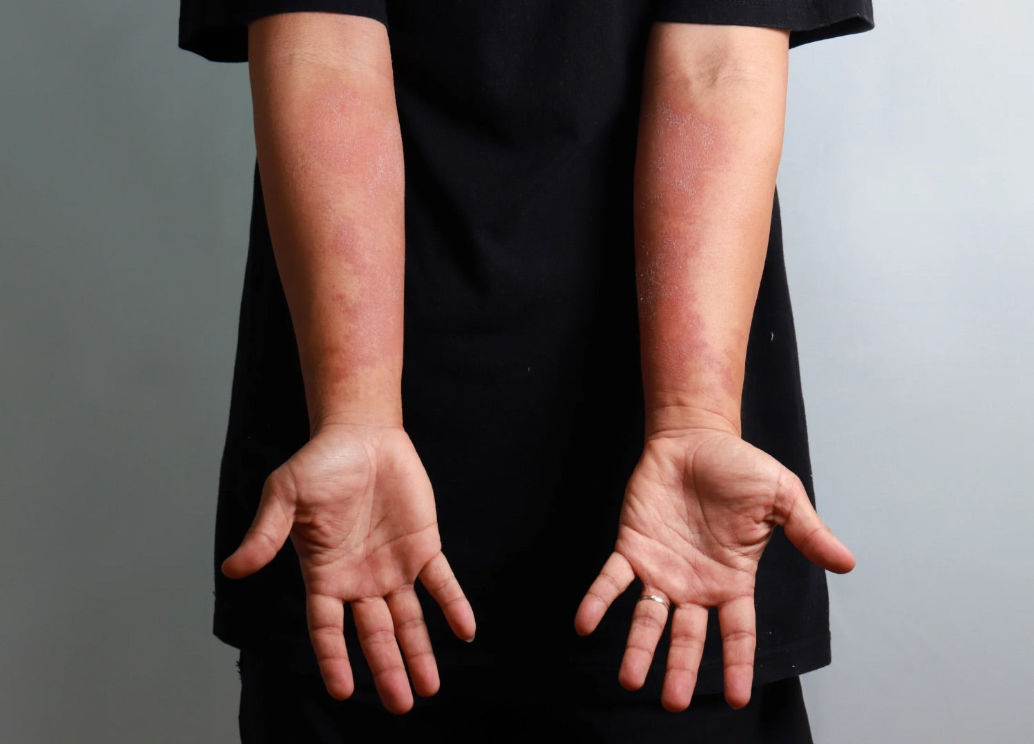 Physiologie der Haut bei Neurodermitis: Wissenswertes 2025